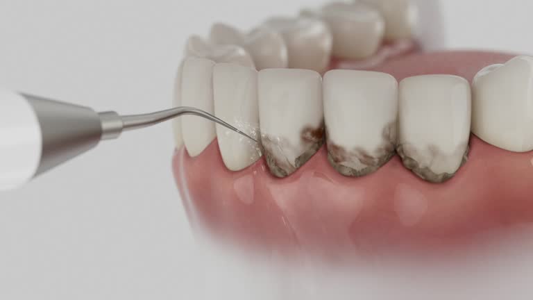 Trusted Wisdom Tooth Removal service in Lebanon, MO - Dentist Open Now